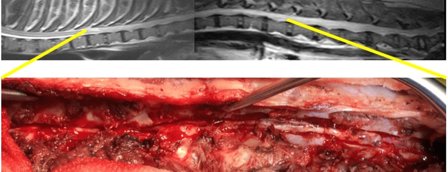 広範囲の椎弓の切除と硬膜切開